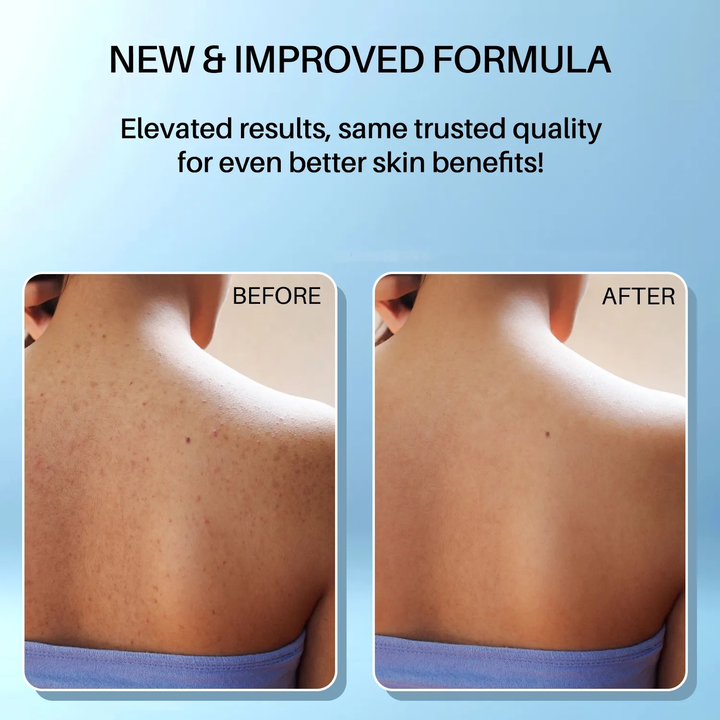DERMDOC 2% SALICYLIC ACID BODY ACNE TEATMENT 100ML